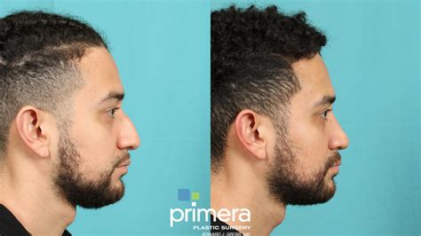 Rhinoplasty Before And After Pictures Case 756 Orlando Florida