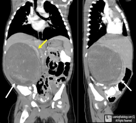 Medical Treatment Pictures For Better Understanding Wilms Tumor