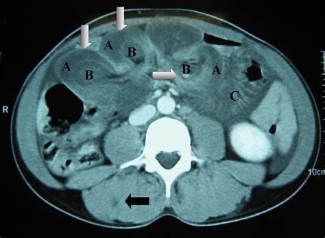 Intussusception Ct Wikidoc