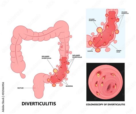 Diverticulosis Polyps Colon Polyps And Diverticulitis Differences And Relationship