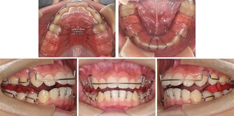 Efficacy Of Orthodontic Treatment Versus Adenotonsillectomy In Children