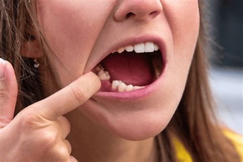 What Are The Dos And Donts After A Wisdom Tooth Removal