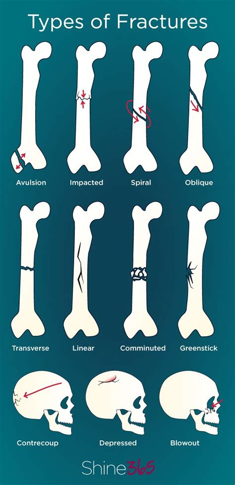 The 25+ best Types of bones ideas on Pinterest | Radiology student ...