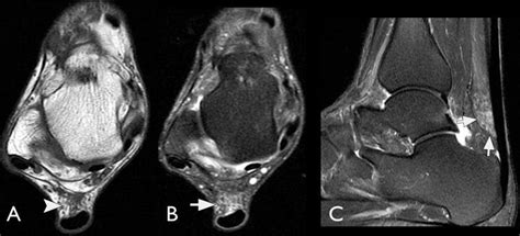 Axial T1 Weighted A Axial T2 Weighted With Fat Suppression B And