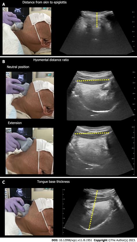 Airway Ultrasound Anesthesia at Jose Derringer blog