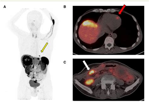 Figure 1 From Added Value Of Molecular Imaging In Myocardial Metastasis Of An Ileal