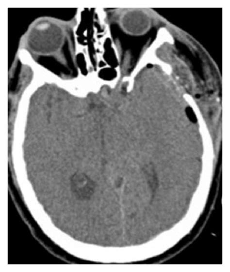 A Noncontrast Axial Computed Tomography Scan Of The Head Done On