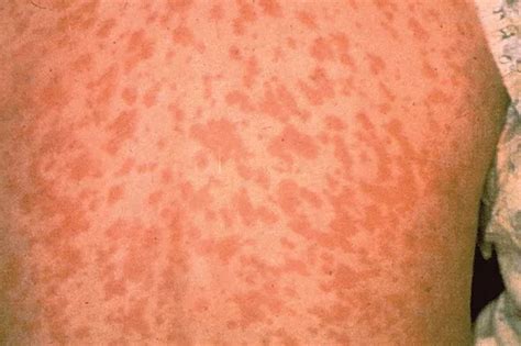 Cases Of Measles Is On The Rise In The South West How Can You Spot