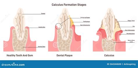 Dental Tartar Or Calculus Formation Stages Dental Plaque Disease