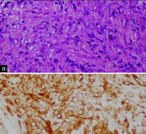 Histopathology A Spindle Cell Proliferation Forming Rough Bundles