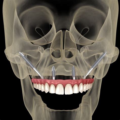 Zygoma Implants A Definitive Guide Smile Science Dental Spa