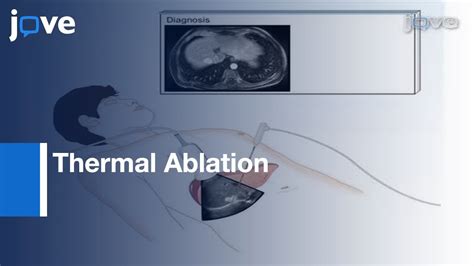 Thermal Ablation For Treatment Of Abdominal Tumors L Protocol Preview Youtube