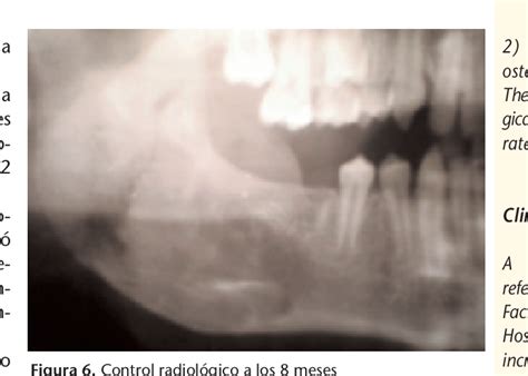 Figure 1 From Fibroma Osificante De Mandibula Presentacion De Un Caso Semantic Scholar