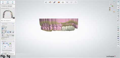 Digitally Fabricated Bulb Obturator Using Virtual Data And 3d Printing