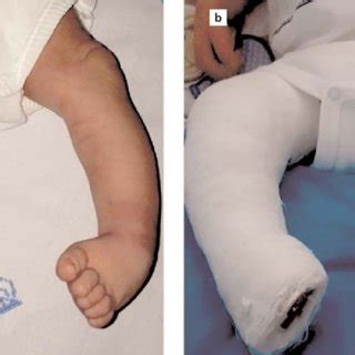 In pes equinovarus deformity (a), the image of long leg casting (b ...