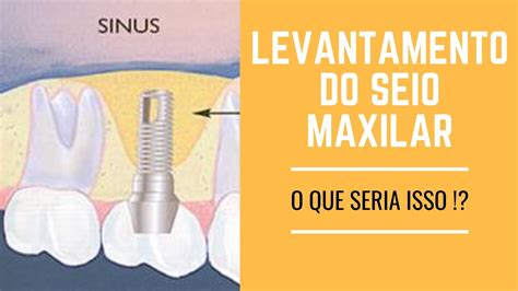 Levantamento Do Seio Maxilar Que Cirurgia Essa Youtube