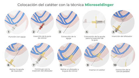 Técnica Microseldinger o Seldinger modificada colocación de PICC