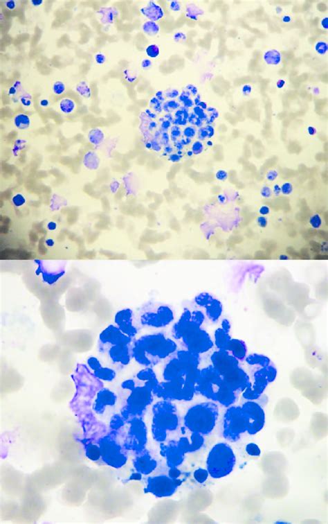 Maygr Nwaldgiemsa Stain Of Bone Marrow Aspirate Smears Patient