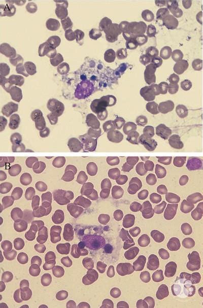 Transient Pelgeroid Change Of Neutrophils In Hemophagocytic