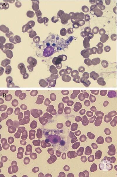 Hemophagocytic Lymphohistiocytosis