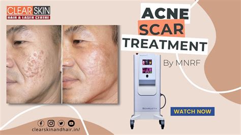 Acne Scar Treatment By Fractional Microneedling Rf Scarlet S Scarlet