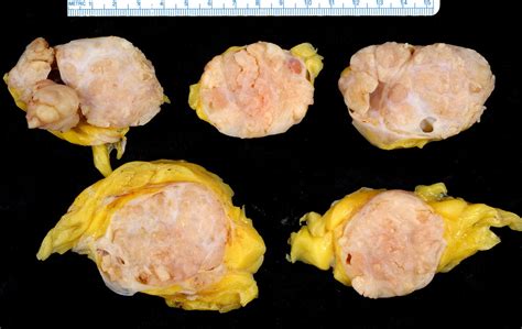 phyllodes tumor gross ed uthman flickr