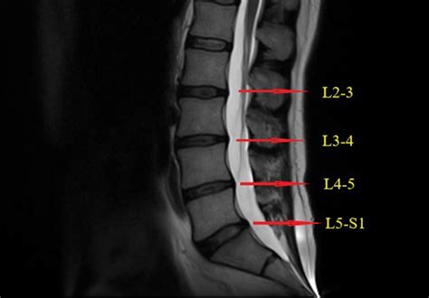 What To Expect During Lumbar Mri