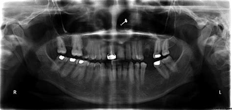 Hypercementosis A Rare Finding In A Patient With Systemic Lupus