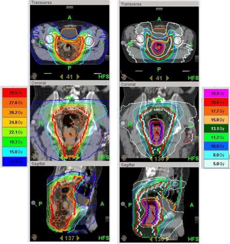 Feasibility Of An Adaptive Strategy In Preoperative Radiochemotherapy For Rectal Cancer With