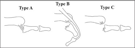 Figure 6 From Palmar Dislocation Of The Thumb Metacarpophalangeal Joint