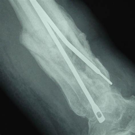 A Pre Operative Anteroposterior And Lateral Radiograph Figure 1b