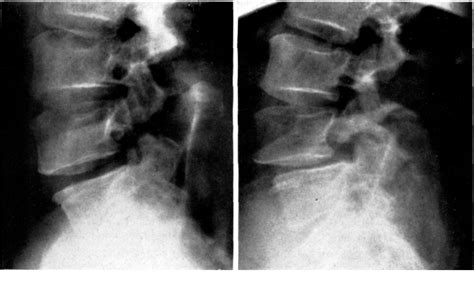 Figure 1 From Spondylolysis — Spondylolisthesis Semantic Scholar