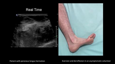 Peroneal Tendonitis Ultrasound