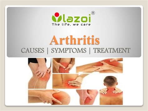 Arthritis : causes, symptoms, treatment and prevention | PPT