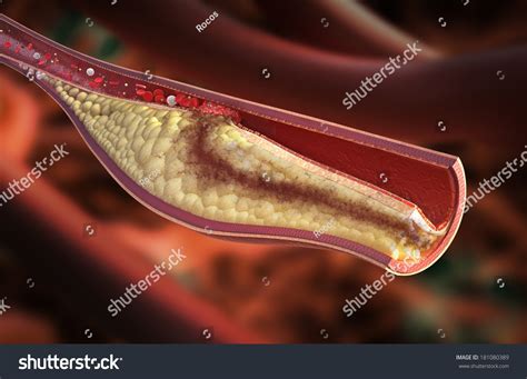 Atherosclerotic Plaque Development. High Detail Image Of Unstable ...