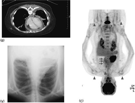 A Chest X Ray Showed An Increased Cardiothoracic Ratio And Bilateral