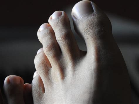 Hallux Rigidus Symptoms And Causes Liebscher And Bracht