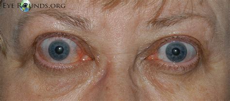 Thyroid Eye Disease Eyerounds