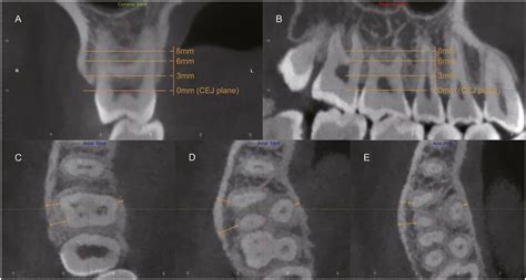 A Preliminary Study Of Buccal And Lingual Alveolar Bone Thickness Of