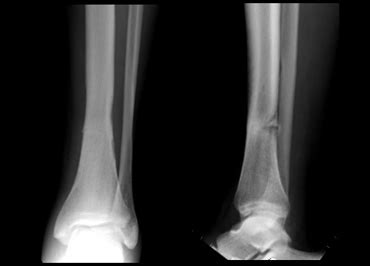 Stress Fracture X Ray Tibia