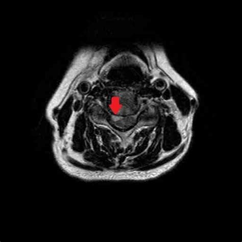 Acute Spinal Subdural Haematoma Ct And Mr Images Pacs