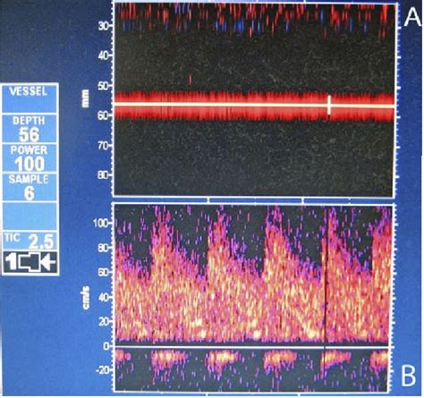 Middle Cerebral Transcranial Doppler Ultrasonography As Seen On M Mode