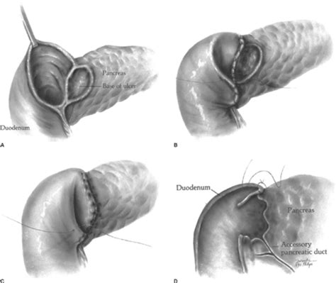 Total Colectomy and Ileorectal Anastomosis | Basicmedical Key