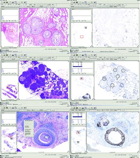 Grading Ductal Carcinoma In Situ Of The Breast Using An Automated