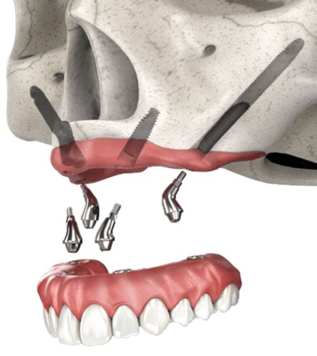 Zygoma Implants | FMS DENTAL HOSPITAL