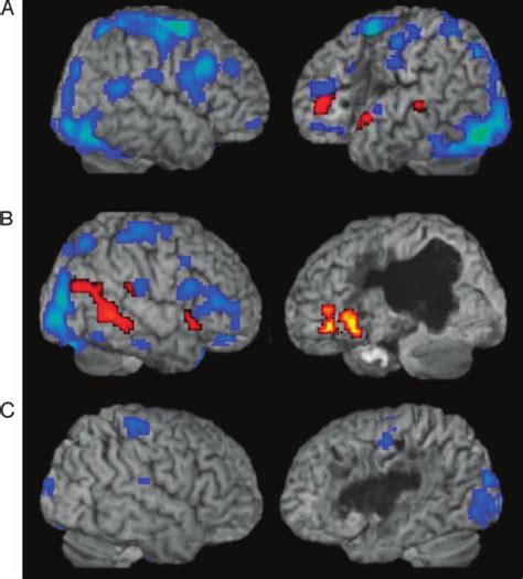 Fmri Activation Maps For All Words Nouns And Verbs For Three Aphasic