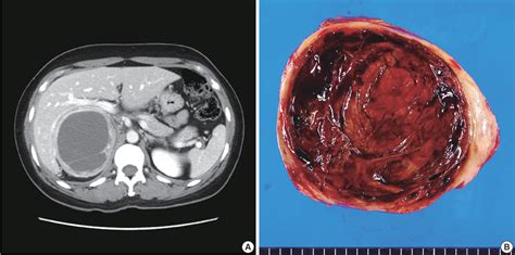 Figure 1 From Composite Pheochromocytoma Or Paraganglioma Of Adrenal Gland A Case Report With