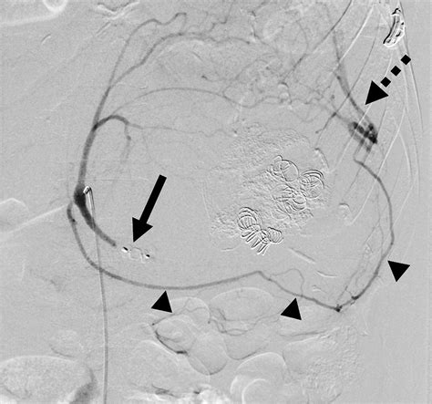 Embolization Of A Giant Splenic Artery Aneurysm Journal Of Vascular And Interventional Radiology