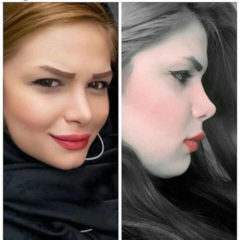 Persian Rhinoplasty Before After 9 Rhinoplasty Cost Pics Reviews