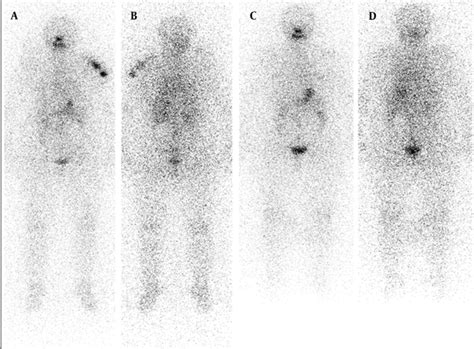 Radioactive Iodine Scan